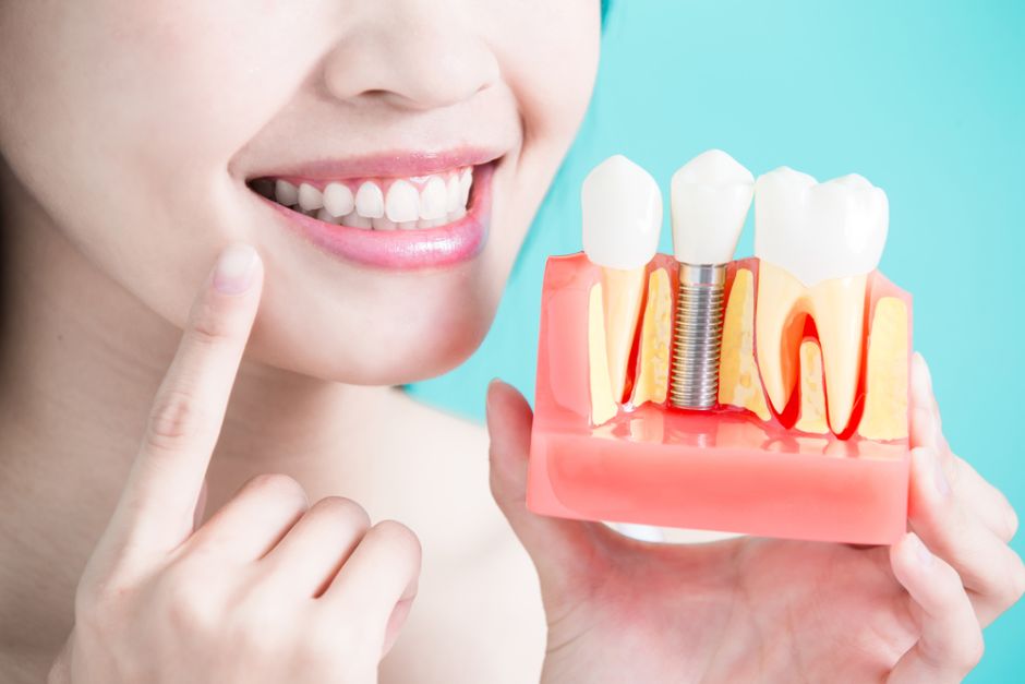 Implantes dentales - protesis dentales